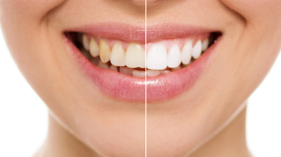 Atlantic Dental Healthcare - Whitening