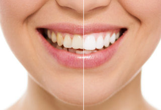 Atlantic Dental Healthcare - Teeth Whitening